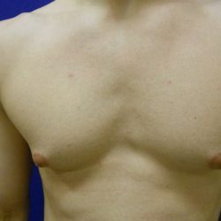 Gynecomastia Before & After Patient #21051