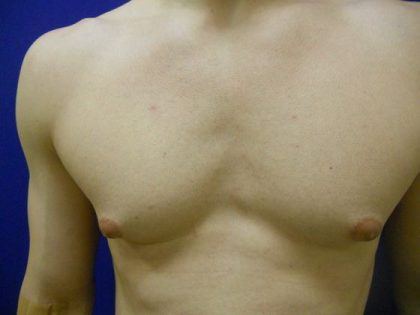 Gynecomastia Before & After Patient #21051