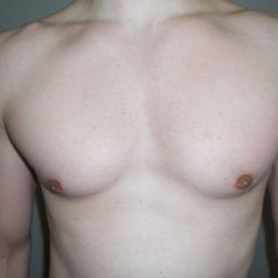 Gynecomastia Before & After Patient #21051