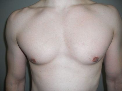 Gynecomastia Before & After Patient #21051