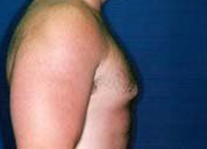 Gynecomastia Before & After Patient #21053