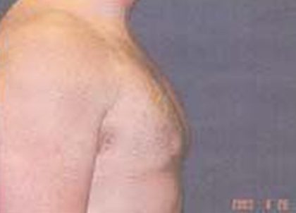 Gynecomastia Before & After Patient #21053