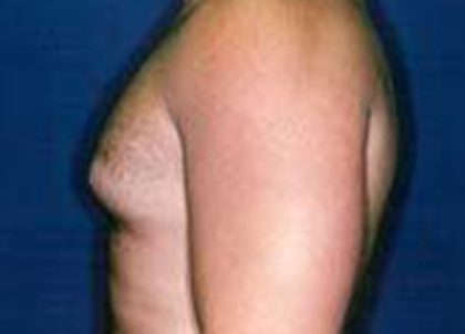 Gynecomastia Before & After Patient #21052