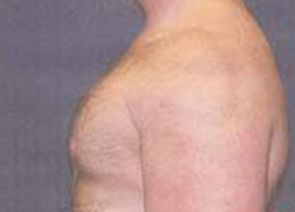 Gynecomastia Before & After Patient #21053