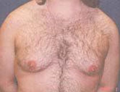 Gynecomastia Before & After Patient #21053