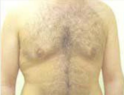 Gynecomastia Before & After Patient #21053