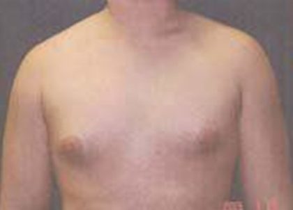 Gynecomastia Before & After Patient #21054