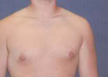 Gynecomastia Before & After Patient #21054