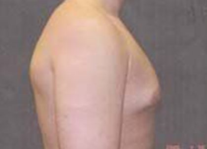 Gynecomastia Before & After Patient #21054