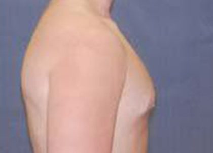 Gynecomastia Before & After Patient #21054