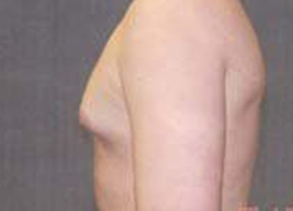 Gynecomastia Before & After Patient #21054