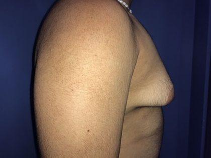 Gynecomastia Before & After Patient #21058