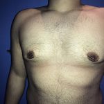 Gynecomastia Before & After Patient #21058