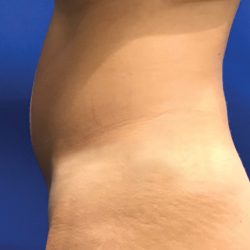 Liposuction Before & After Patient #21133