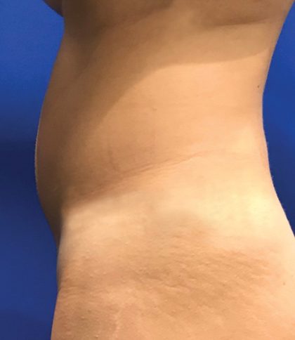 Liposuction Before & After Patient #21133