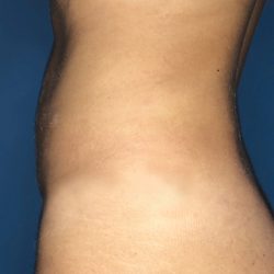 Liposuction Before & After Patient #21133