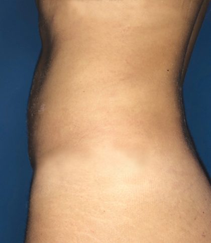 Liposuction Before & After Patient #21133