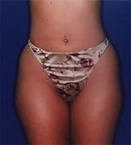 Liposuction Before & After Patient #21239