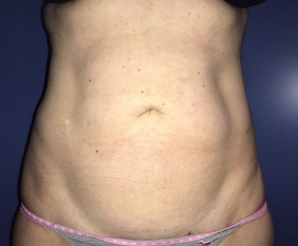 Liposuction Before & After Patient #21240