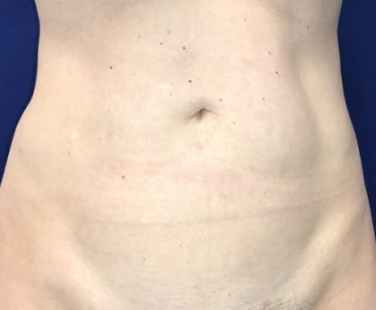 Liposuction Before & After Patient #21240