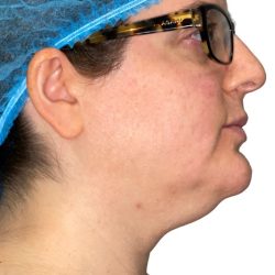Liposuction Before & After Patient #21242