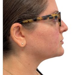 Liposuction Before & After Patient #21242
