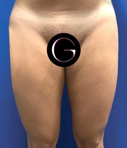 Liposuction Before & After Patient #21100