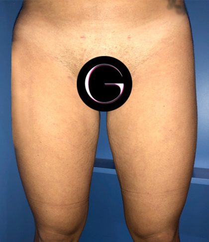 Liposuction Before & After Patient #21100