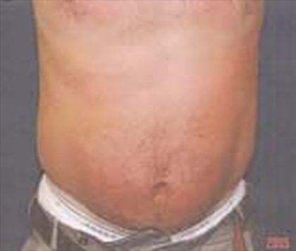 Liposuction Before & After Patient #21043