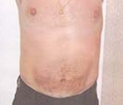 Liposuction Before & After Patient #21043