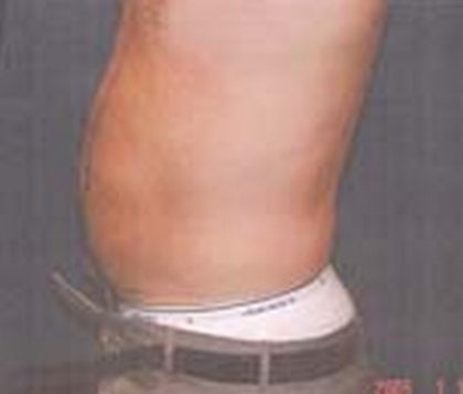 Liposuction Before & After Patient #21043