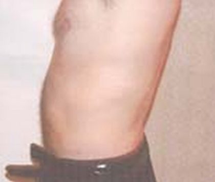 Liposuction Before & After Patient #21043