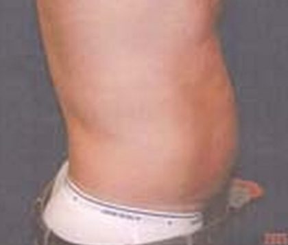 Liposuction Before & After Patient #21043