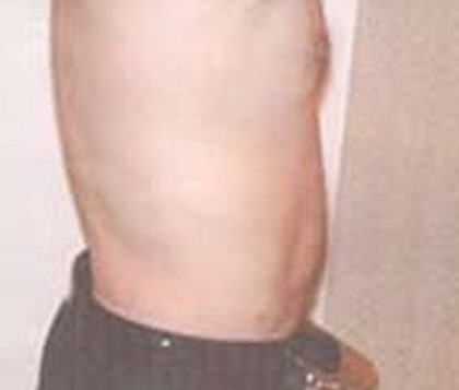 Liposuction Before & After Patient #21043