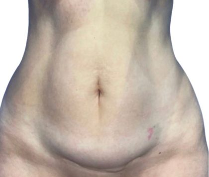 Tummy Tuck Before & After Patient #21266