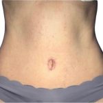 Tummy Tuck Before & After Patient #21266