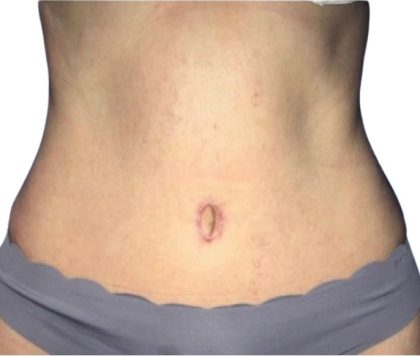 Tummy Tuck Before & After Patient #21266