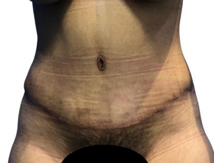 Tummy Tuck Before & After Patient #21267