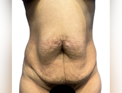 Tummy Tuck Before & After Patient #21267