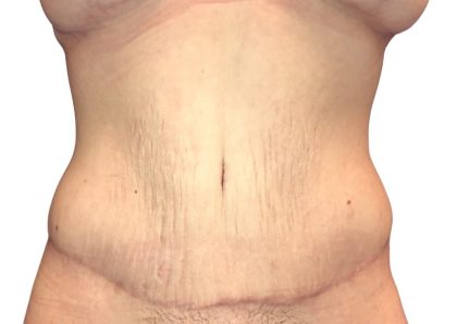 Tummy Tuck Before & After Patient #21268