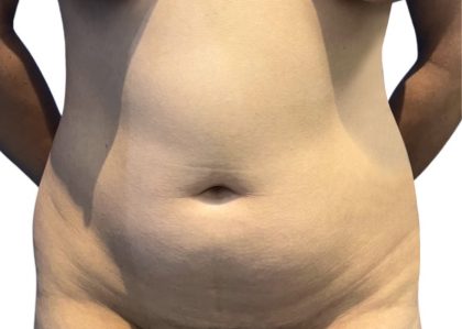 Liposuction Before & After Patient #21273