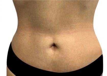 Liposuction Before & After Patient #21273