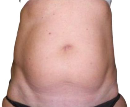 Liposuction Before & After Patient #21276