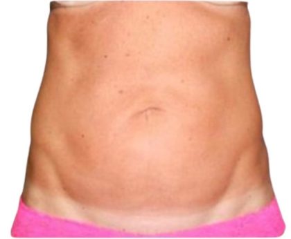 Liposuction Before & After Patient #21276