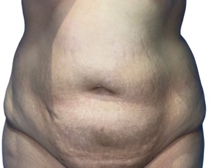 Tummy Tuck Before & After Patient #21278