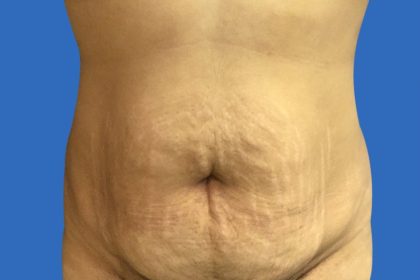 Tummy Tuck Before & After Patient #21243