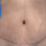 Tummy Tuck Before & After Patient #21243