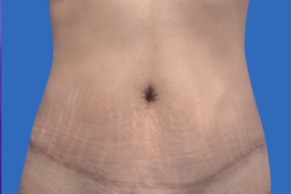 Tummy Tuck Before & After Patient #21243