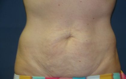 Tummy Tuck Before & After Patient #21244