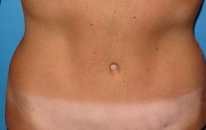Tummy Tuck Before & After Patient #21244